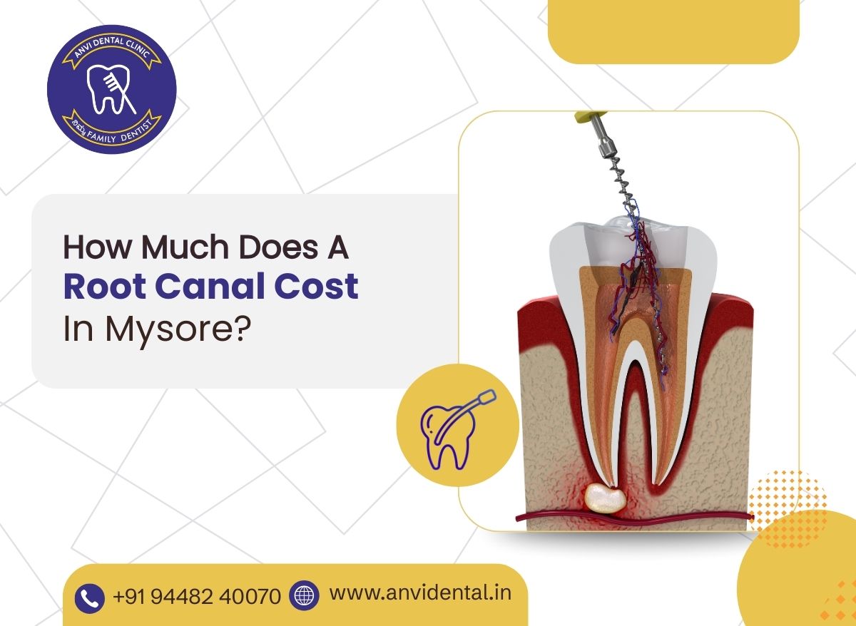 how much does a root canal cost in mysore